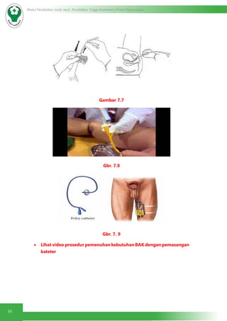35
Modul Pendidikan Jarak Jauh, Pendidikan Tinggi Kesehatan Prodi Keperawatan
Gambar 7.7
Gbr. 7.8
Gbr. 7. 9
•	 Lihat video prosedur pemenuhan kebutuhan BAK dengan pemasangan
kateter
 