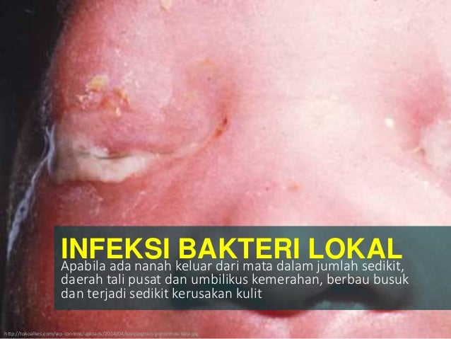 Modul 6 kb 5 asuhan neonatus dan bayi dengan bisulan Modul 6 kb 5 asuhan neonatus dan bayi dengan bisulan