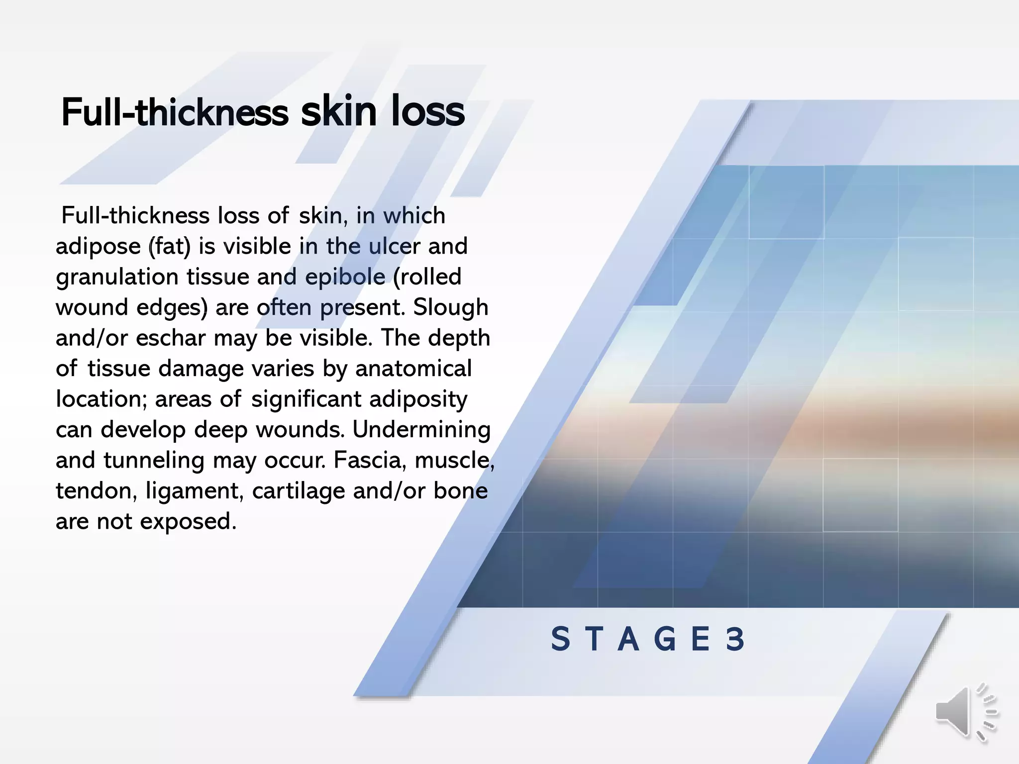 S T A G E 3
Full-thickness loss of skin, in which
adipose (fat) is visible in the ulcer and
granulation tissue and epibole (rolled
wound edges) are often present. Slough
and/or eschar may be visible. The depth
of tissue damage varies by anatomical
location; areas of significant adiposity
can develop deep wounds. Undermining
and tunneling may occur. Fascia, muscle,
tendon, ligament, cartilage and/or bone
are not exposed.
Full-thickness skin loss
 