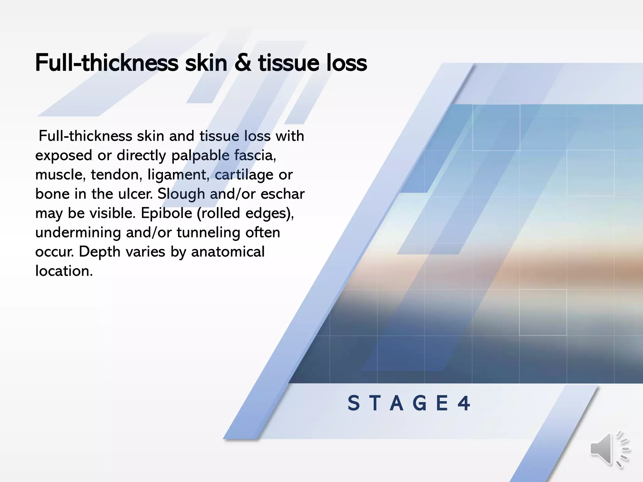 S T A G E 4
Full-thickness skin and tissue loss with
exposed or directly palpable fascia,
muscle, tendon, ligament, cartilage or
bone in the ulcer. Slough and/or eschar
may be visible. Epibole (rolled edges),
undermining and/or tunneling often
occur. Depth varies by anatomical
location.
Full-thickness skin & tissue loss
 