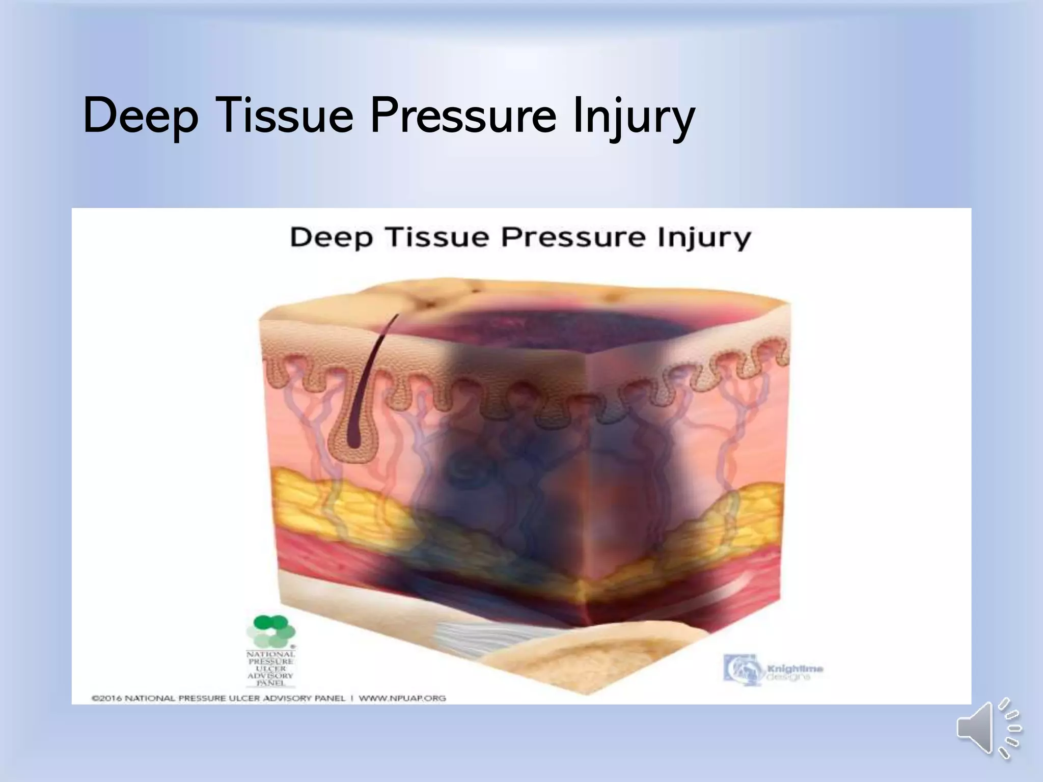 Deep Tissue Pressure Injury
 