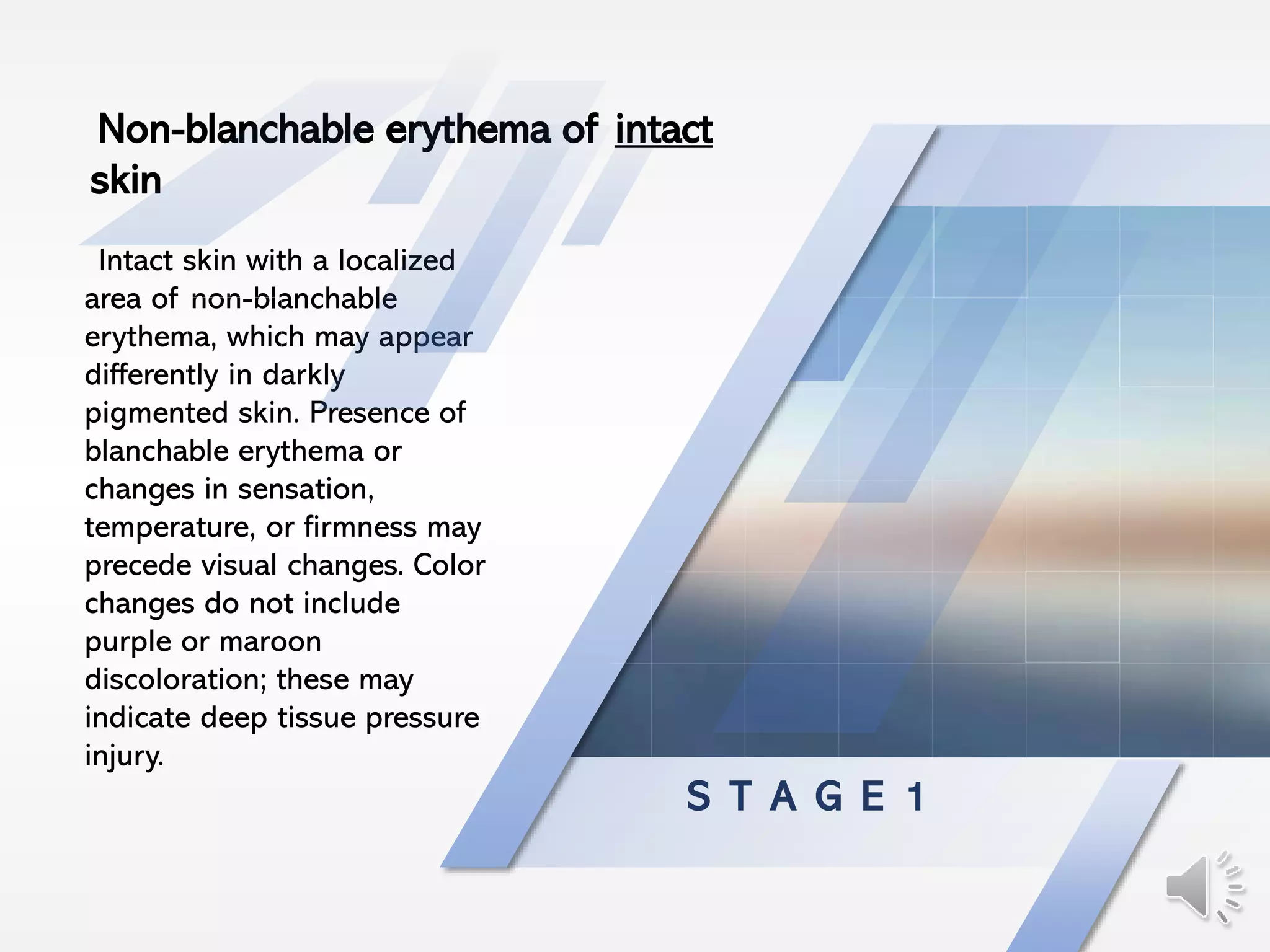 S T A G E 1
Intact skin with a localized
area of non-blanchable
erythema, which may appear
differently in darkly
pigmented skin. Presence of
blanchable erythema or
changes in sensation,
temperature, or firmness may
precede visual changes. Color
changes do not include
purple or maroon
discoloration; these may
indicate deep tissue pressure
injury.
Non-blanchable erythema of intact
skin
 
