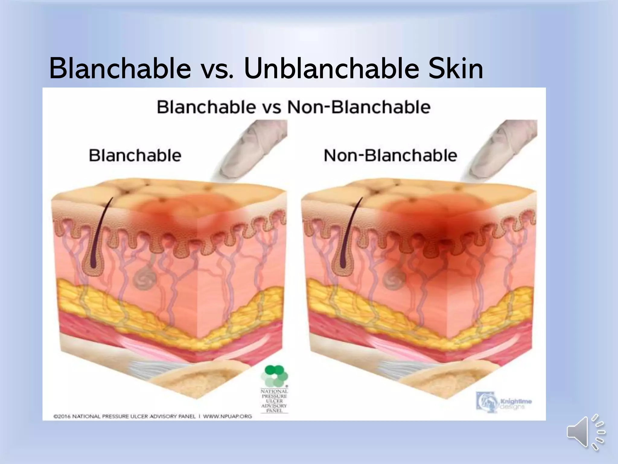 Blanchable vs. Unblanchable Skin
 