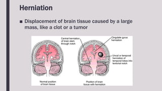 Herniation
■ Displacement of brain tissue caused by a large
mass, like a clot or a tumor
 