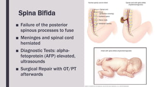 Spina Bifida
■ Failure of the posterior
spinous processes to fuse
■ Meninges and spinal cord
herniated
■ Diagnostic Tests: alpha-
fetoprotein (AFP) elevated,
ultrasounds
■ Surgical Repair with OT/PT
afterwards
 