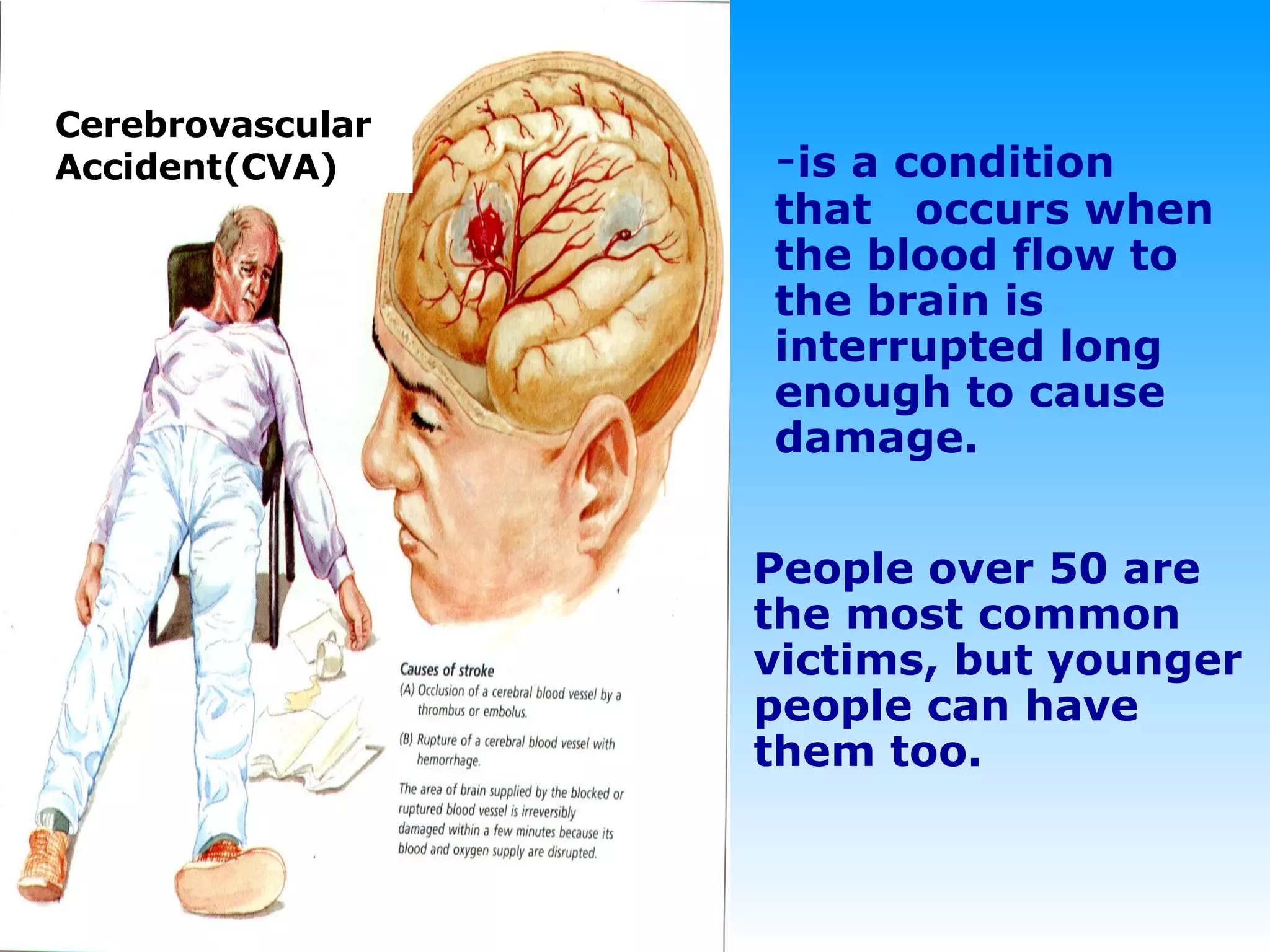 Stroke Cerebrovascular  Accident(CVA) - is a condition that  occurs when the blood flow to the brain is interrupted long enough to cause damage. People over 50 are the most common victims, but younger people can have them   too. 