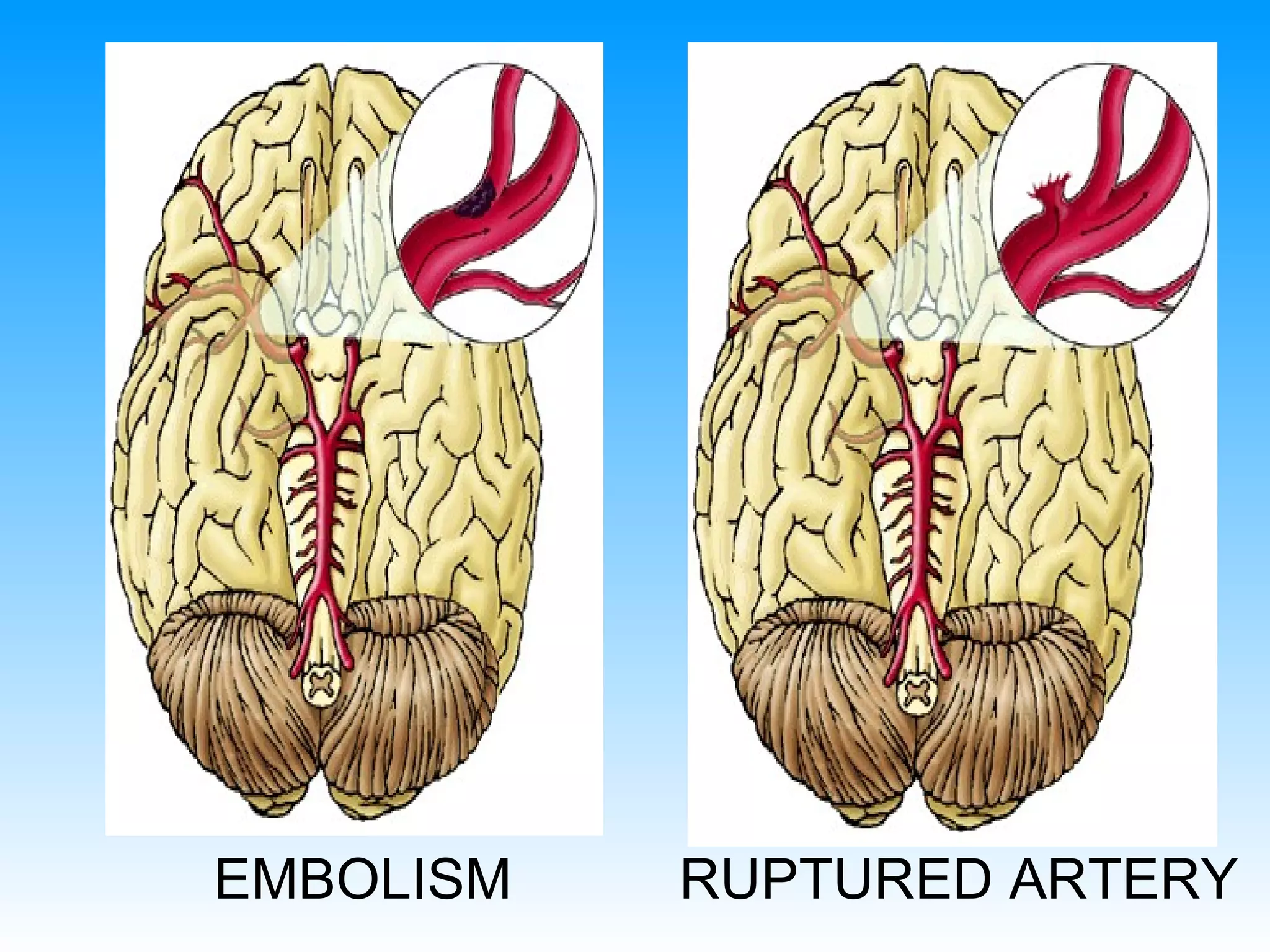 EMBOLISM RUPTURED ARTERY 