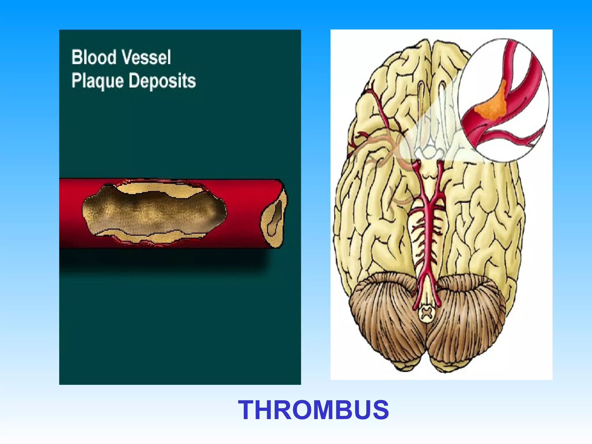 THROMBUS 
