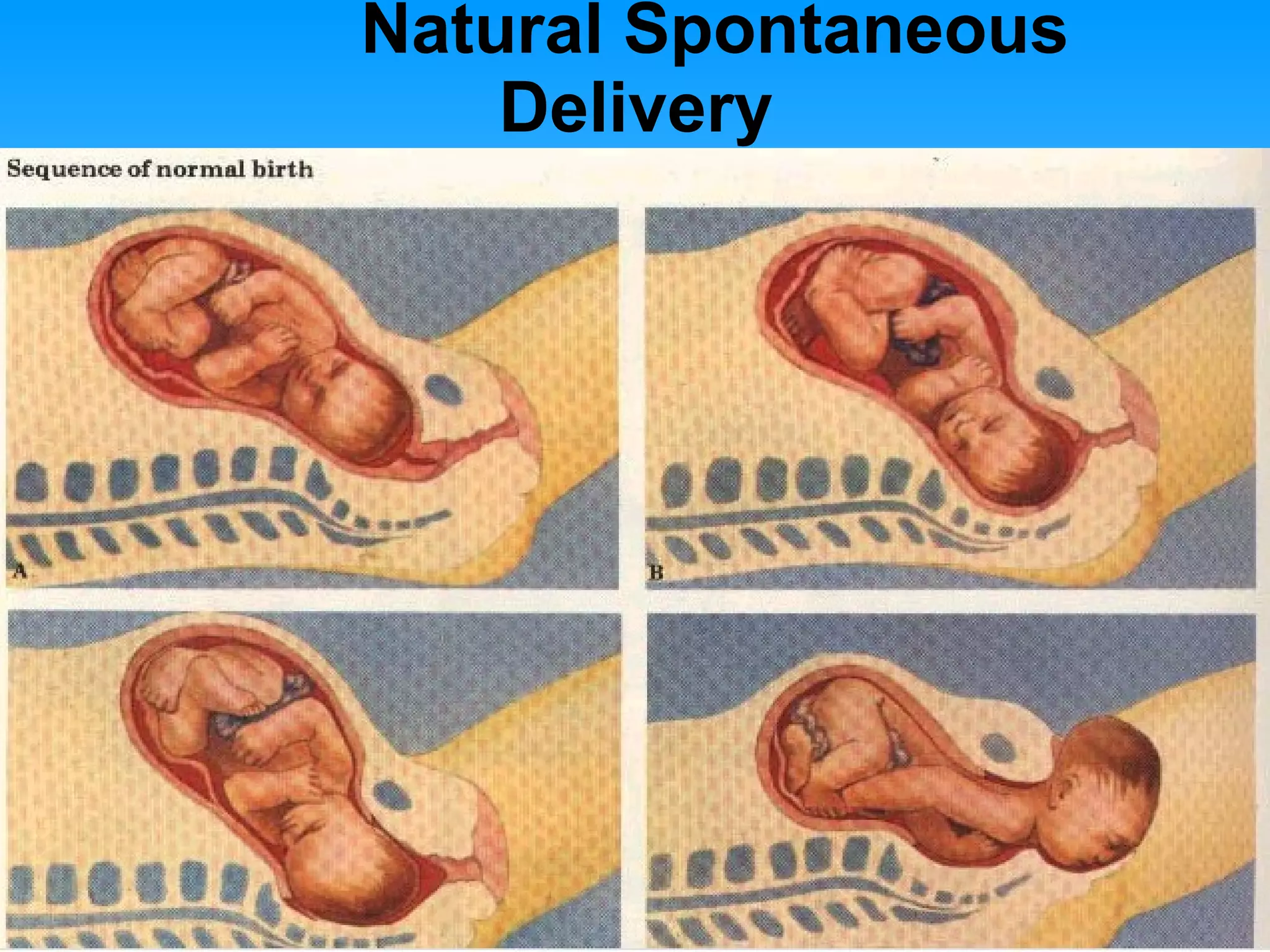 Natural Spontaneous Delivery 