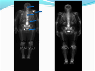Pre-treatment:   Post-treatment:
  PSA 250           PSA <0.1
 
