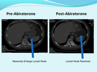 Pre-Abiraterone                   Post-Abiraterone




   Massively Enlarge Lymph Node        Lymph Node Resolved
 