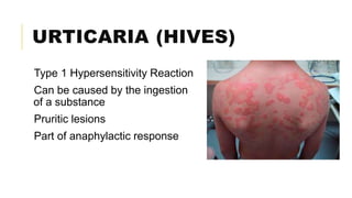 URTICARIA (HIVES)
Type 1 Hypersensitivity Reaction
Can be caused by the ingestion
of a substance
Pruritic lesions
Part of anaphylactic response
 
