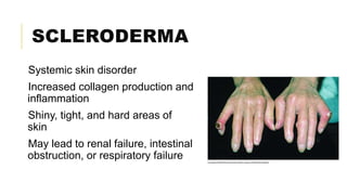 SCLERODERMA
Systemic skin disorder
Increased collagen production and
inflammation
Shiny, tight, and hard areas of
skin
May lead to renal failure, intestinal
obstruction, or respiratory failure
 