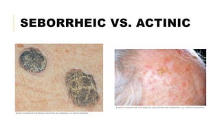 SEBORRHEIC VS. ACTINIC
 