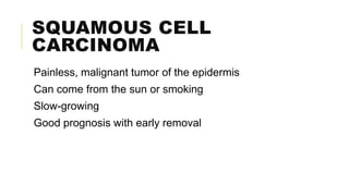 SQUAMOUS CELL
CARCINOMA
Painless, malignant tumor of the epidermis
Can come from the sun or smoking
Slow-growing
Good prognosis with early removal
 
