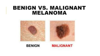 BENIGN VS. MALIGNANT
MELANOMA
 