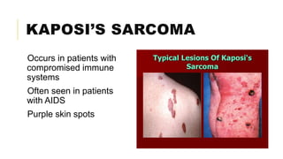 KAPOSI’S SARCOMA
Occurs in patients with
compromised immune
systems
Often seen in patients
with AIDS
Purple skin spots
 