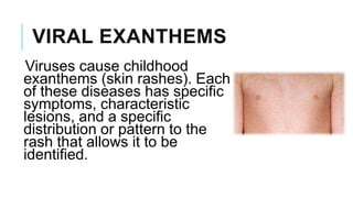 VIRAL EXANTHEMS
Viruses cause childhood
exanthems (skin rashes). Each
of these diseases has specific
symptoms, characteristic
lesions, and a specific
distribution or pattern to the
rash that allows it to be
identified.
 
