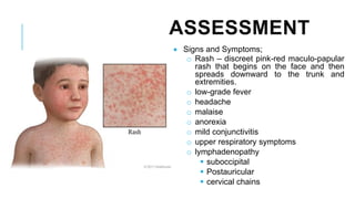 ASSESSMENT
• Signs and Symptoms;
o Rash – discreet pink-red maculo-papular
rash that begins on the face and then
spreads downward to the trunk and
extremities.
o low-grade fever
o headache
o malaise
o anorexia
o mild conjunctivitis
o upper respiratory symptoms
o lymphadenopathy
▪ suboccipital
▪ Postauricular
▪ cervical chains
 