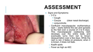ASSESSMENT
• Signs and Symptoms:
o 3 C’s:
▪ Cough
▪ Coryza (clear nasal discharge)
▪ conjunctivitis
o Confluent maculopapular, erythematous
rash – starts behind the ear and spreads
to the feet over a course of 3 to 6 days.
This maculopapular coalescing rash
develops over the entire body and
eventually turns from red to brown
desquamation over a few days. While the
rash is red, it fades on pressure; when it
is brown, it does not fade.
o Koplik spots
o Fever as high as 40C
 