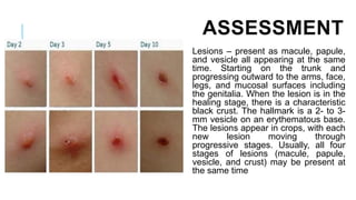 ASSESSMENT
Lesions – present as macule, papule,
and vesicle all appearing at the same
time. Starting on the trunk and
progressing outward to the arms, face,
legs, and mucosal surfaces including
the genitalia. When the lesion is in the
healing stage, there is a characteristic
black crust. The hallmark is a 2- to 3-
mm vesicle on an erythematous base.
The lesions appear in crops, with each
new lesion moving through
progressive stages. Usually, all four
stages of lesions (macule, papule,
vesicle, and crust) may be present at
the same time
 