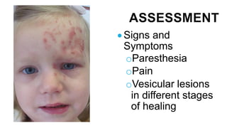 ASSESSMENT
• Signs and
Symptoms
oParesthesia
oPain
oVesicular lesions
in different stages
of healing
 