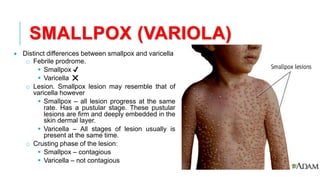 SMALLPOX (VARIOLA)
• Distinct differences between smallpox and varicella
o Febrile prodrome.
▪ Smallpox ✔
▪ Varicella ❌
o Lesion. Smallpox lesion may resemble that of
varicella however
▪ Smallpox – all lesion progress at the same
rate. Has a pustular stage. These pustular
lesions are firm and deeply embedded in the
skin dermal layer.
▪ Varicella – All stages of lesion usually is
present at the same time.
o Crusting phase of the lesion:
▪ Smallpox – contagious
▪ Varicella – not contagious
 