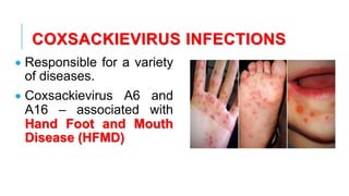 COXSACKIEVIRUS INFECTIONS
• Responsible for a variety
of diseases.
• Coxsackievirus A6 and
A16 – associated with
Hand Foot and Mouth
Disease (HFMD)
 