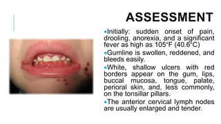 ASSESSMENT
•Initially: sudden onset of pain,
drooling, anorexia, and a significant
fever as high as 105°F (40.6°C)
•Gumline is swollen, reddened, and
bleeds easily.
•White, shallow ulcers with red
borders appear on the gum, lips,
buccal mucosa, tongue, palate,
perioral skin, and, less commonly,
on the tonsillar pillars.
•The anterior cervical lymph nodes
are usually enlarged and tender.
 