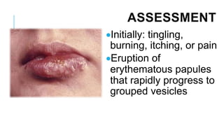 ASSESSMENT
•Initially: tingling,
burning, itching, or pain
•Eruption of
erythematous papules
that rapidly progress to
grouped vesicles
 