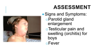 ASSESSMENT
• Signs and Symptoms:
oParotid gland
enlargement
oTesticular pain and
swelling (orchitis) for
boys
oFever
 
