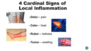 Dolor – pain
Calor – heat
Rubor – redness
Tumor – swelling
 