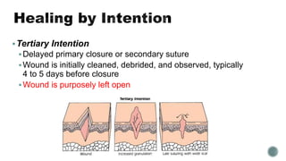 Tertiary Intention
Delayed primary closure or secondary suture
Wound is initially cleaned, debrided, and observed, typically
4 to 5 days before closure
Wound is purposely left open
 