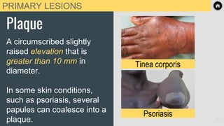 PRIMARY LESIONS
Plaque
A circumscribed slightly
raised elevation that is
greater than 10 mm in
diameter.
In some skin conditions,
such as psoriasis, several
papules can coalesce into a
plaque.
Tinea corporis
Psoriasis 10
 