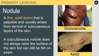 PRIMARY LESIONS
Nodule
A firm, solid lesion that is
palpable and usually arises
from dermal or subcutaneous
layers of the skin.
A subcutaneous nodule does
not always raise the surface of
the skin but can still be felt on
exam.
Keloid
Onchocercoma
11
 