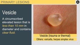 PRIMARY LESIONS
Vesicle
A circumscribed
elevated lesion that is
less than 10 mm in
diameter and contains
clear fluid.
Vesicle (trauma or thermal)
Others: varicella, herpes simplex virus
12
 