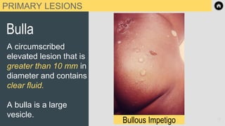 PRIMARY LESIONS
Bulla
A circumscribed
elevated lesion that is
greater than 10 mm in
diameter and contains
clear fluid.
A bulla is a large
vesicle. l
Bullous Impetigo 13
 