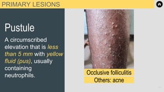 PRIMARY LESIONS
Pustule
A circumscribed
elevation that is less
than 5 mm with yellow
fluid (pus), usually
containing
neutrophils. Occlusive folliculitis
Others: acne
14
 