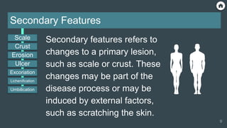Secondary Features
Secondary features refers to
changes to a primary lesion,
such as scale or crust. These
changes may be part of the
disease process or may be
induced by external factors,
such as scratching the skin.
Scale
Ulcer
Erosion
Crust
Excoriation
Lichenification
Umbilication
17
 