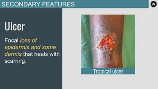 SECONDARY FEATURES
Ulcer
Focal loss of
epidermis and some
dermis that heals with
scarring.
Tropical ulcer
21
 