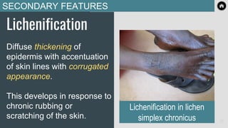 SECONDARY FEATURES
Lichenification
Diffuse thickening of
epidermis with accentuation
of skin lines with corrugated
appearance.
This develops in response to
chronic rubbing or
scratching of the skin.
Lichenification in lichen
simplex chronicus 23
 