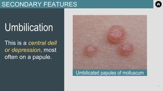 SECONDARY FEATURES
Umbilication
This is a central dell
or depression, most
often on a papule.
Umbilicated papules of molluscum
24
 