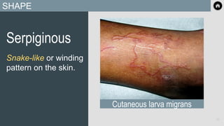 SHAPE
Serpiginous
Snake-like or winding
pattern on the skin.
Cutaneous larva migrans
28
 