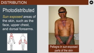 DISTRIBUTION
Photodistributed
Sun exposed areas of
the skin, such as the
face, upper chest,
and dorsal forearms.
Pellagra in sun-exposed
parts of the skin 32
 