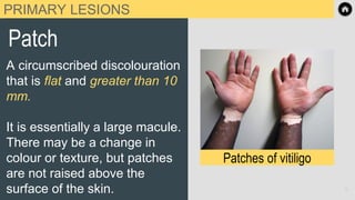 PRIMARY LESIONS
Patch
A circumscribed discolouration
that is flat and greater than 10
mm.
It is essentially a large macule.
There may be a change in
colour or texture, but patches
are not raised above the
surface of the skin.
Patches of vitiligo
8
 