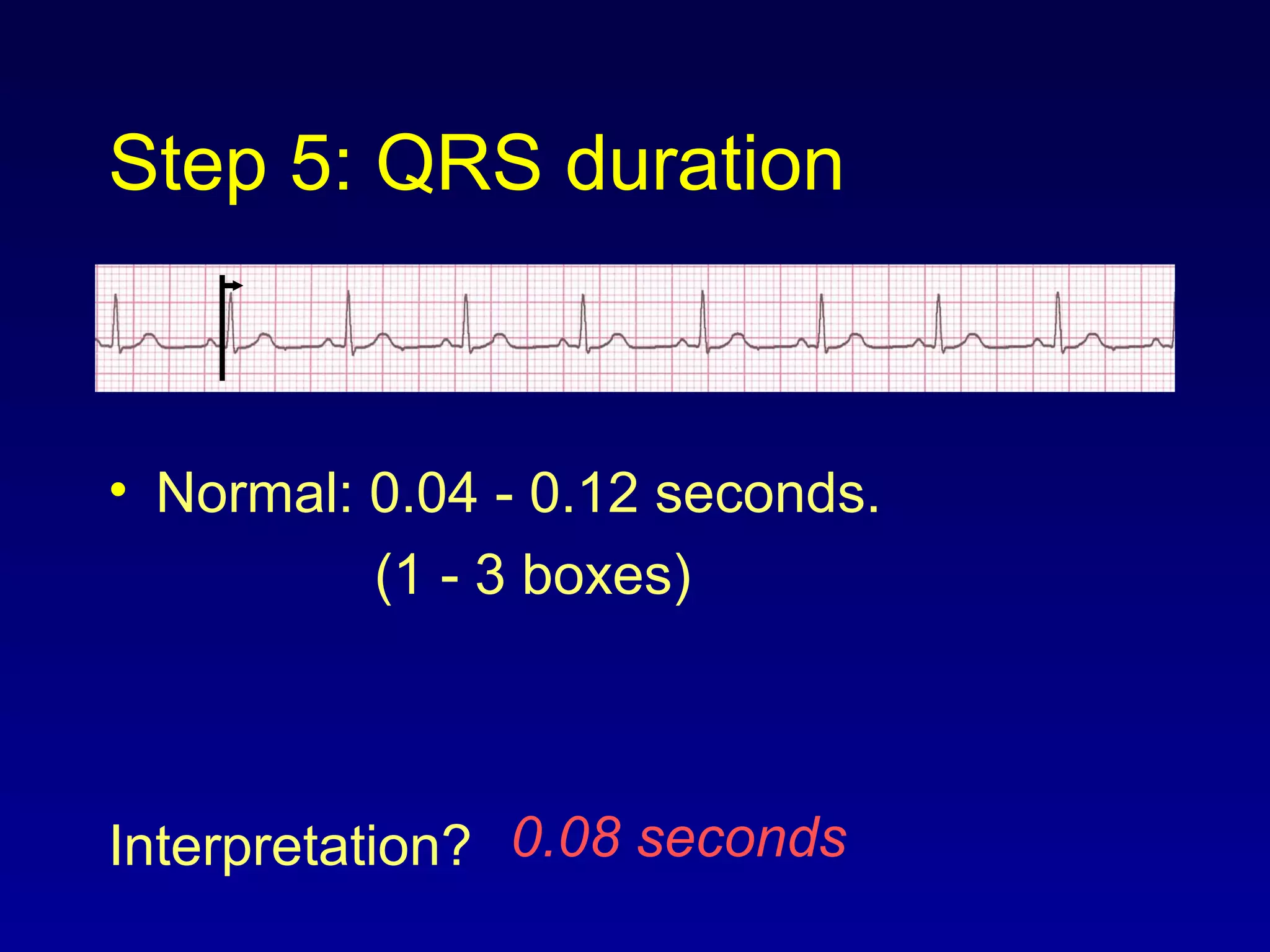 Step 5: QRS duration
• Normal: 0.04 - 0.12 seconds.
(1 - 3 boxes)
Interpretation? 0.08 seconds
 