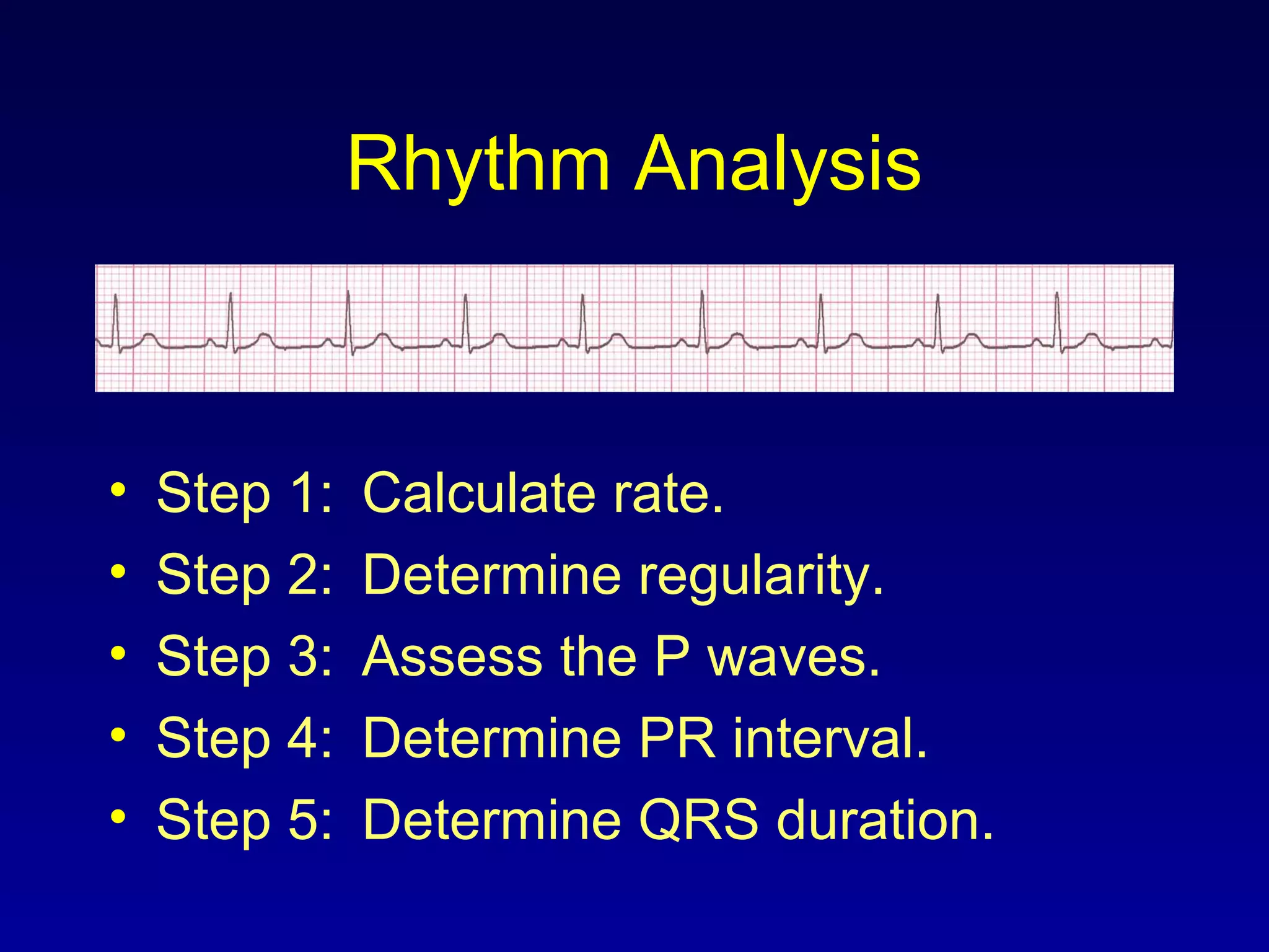 Rhythm Analysis
• Step 1: Calculate rate.
• Step 2: Determine regularity.
• Step 3: Assess the P waves.
• Step 4: Determine PR interval.
• Step 5: Determine QRS duration.
 