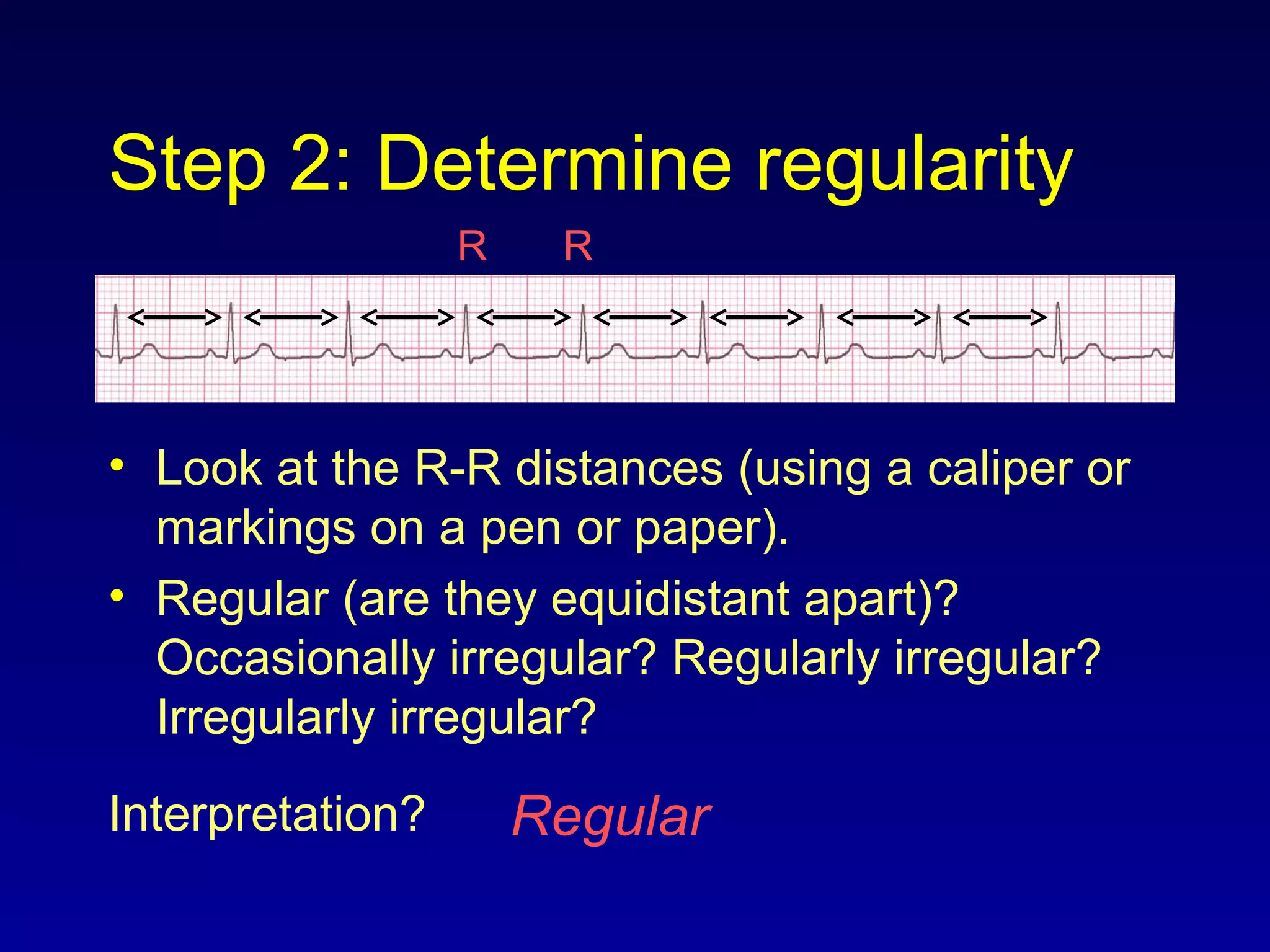 Step 2: Determine regularity
• Look at the R-R distances (using a caliper or
markings on a pen or paper).
• Regular (are they equidistant apart)?
Occasionally irregular? Regularly irregular?
Irregularly irregular?
Interpretation? Regular
R R
 