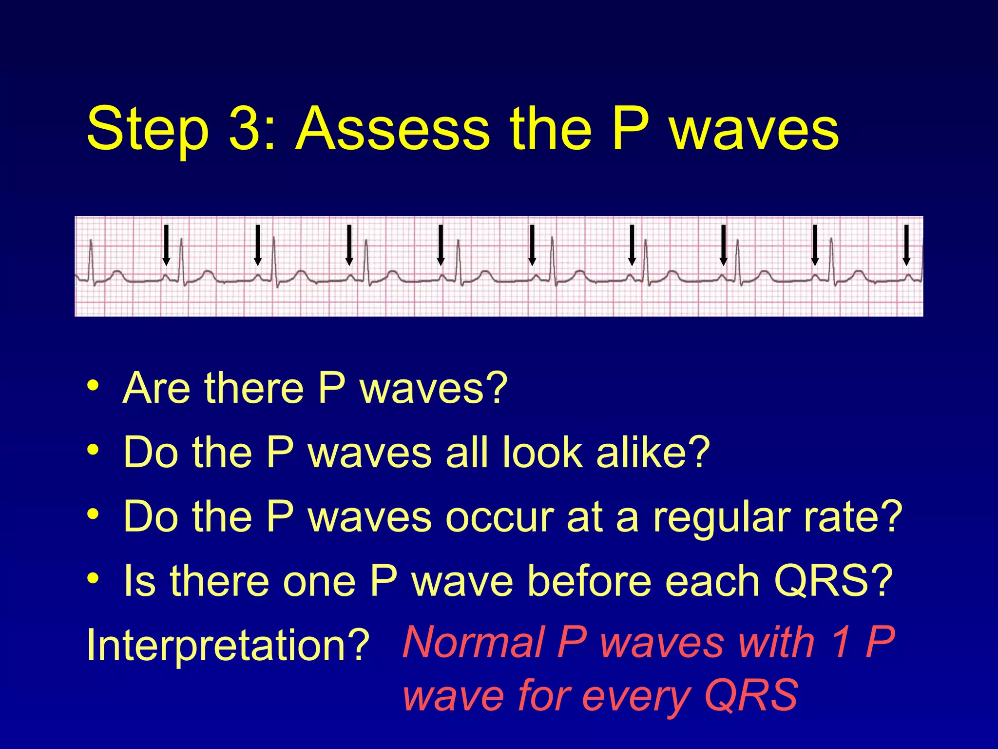 Step 3: Assess the P waves
• Are there P waves?
• Do the P waves all look alike?
• Do the P waves occur at a regular rate?
• Is there one P wave before each QRS?
Interpretation? Normal P waves with 1 P
wave for every QRS
 