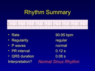 Rhythm Summary
• Rate 90-95 bpm
• Regularity regular
• P waves normal
• PR interval 0.12 s
• QRS duration 0.08 s
Interpretation? Normal Sinus Rhythm
 